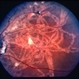Ocular Myiasis